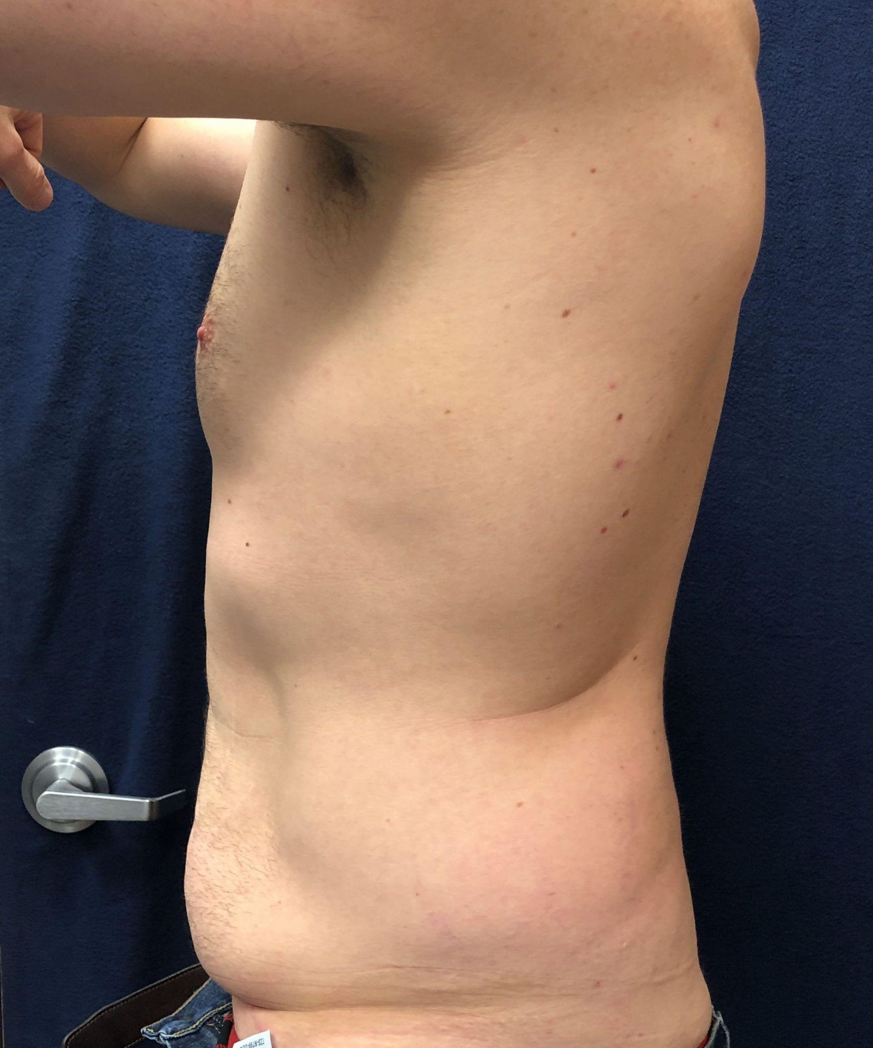 powertuck patient