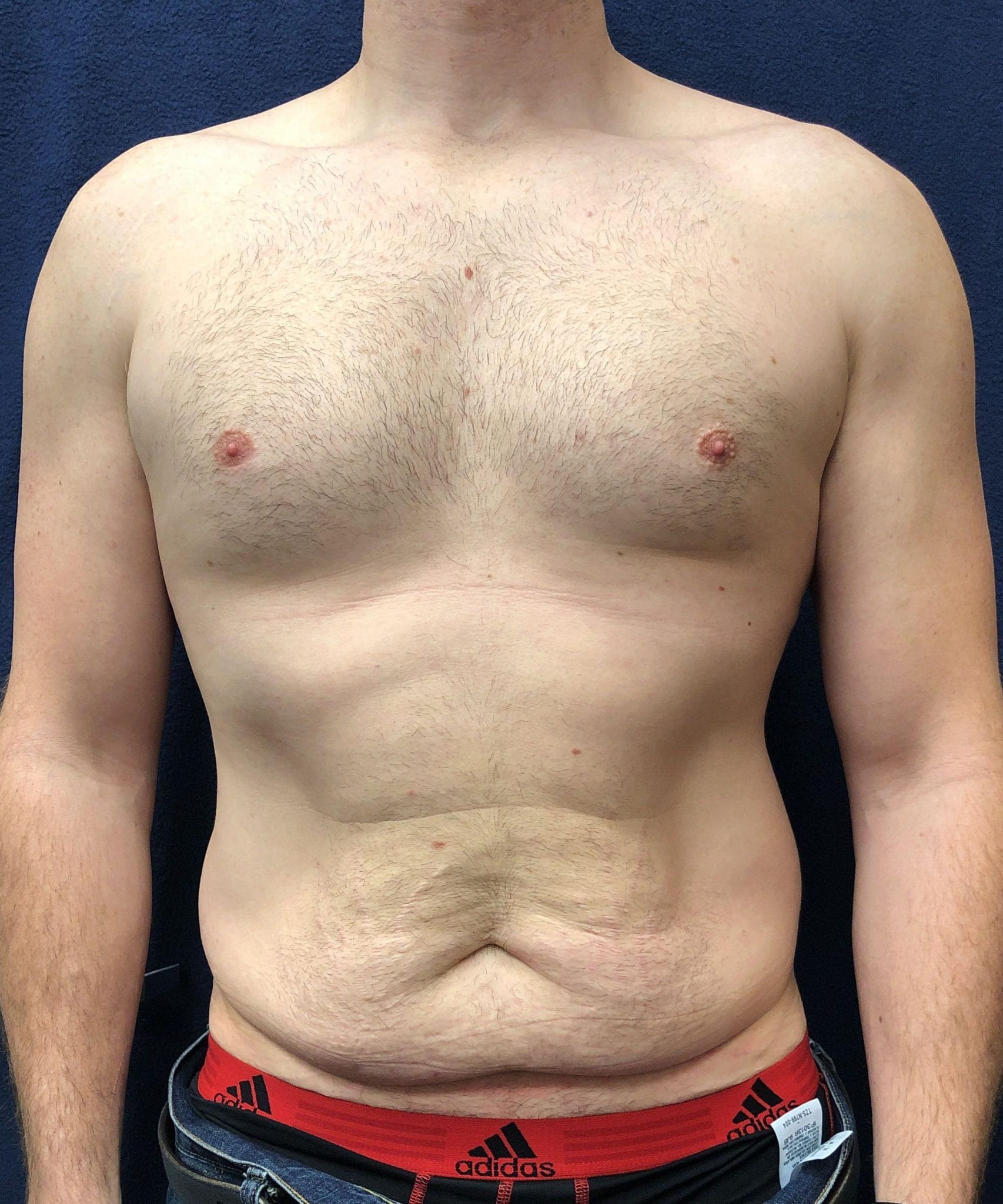 powertuck patient