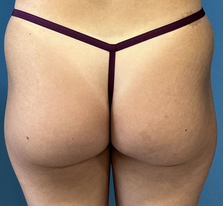 sculptra butt lift patient