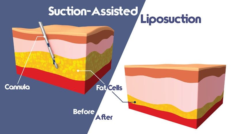 suction assited liposuction infographic