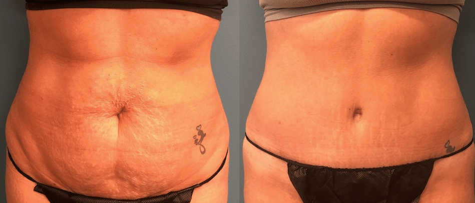 tummy tuck results