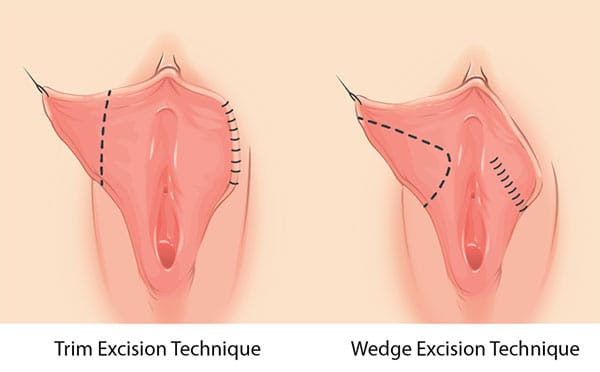 labiaplasty infographic