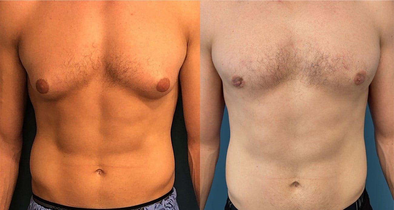 male breast reduction results