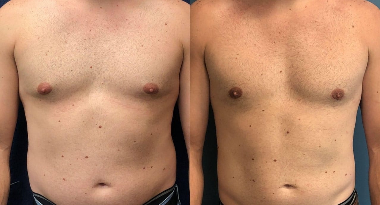 male breast reduction results
