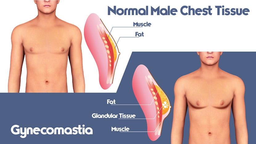 gynecomastia infographic