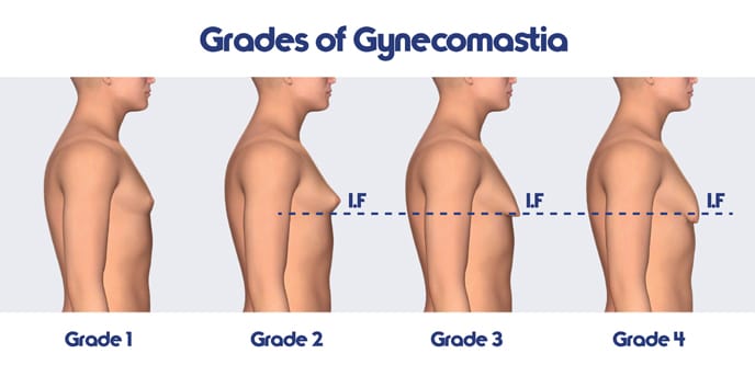 gynecomastia infographic