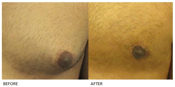 male breast reduction results