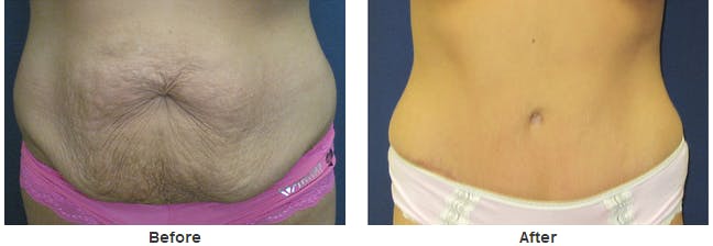 tummy tuck results