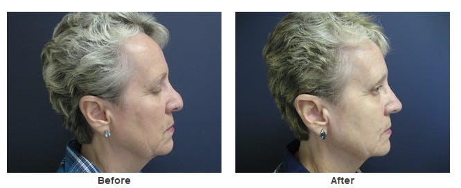 ear surgery patient