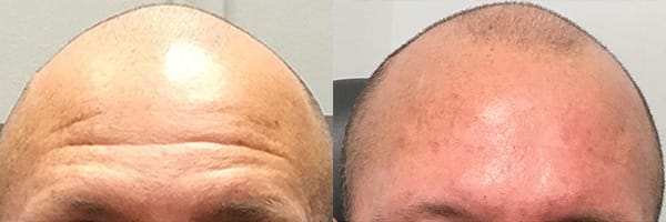 before and after botox