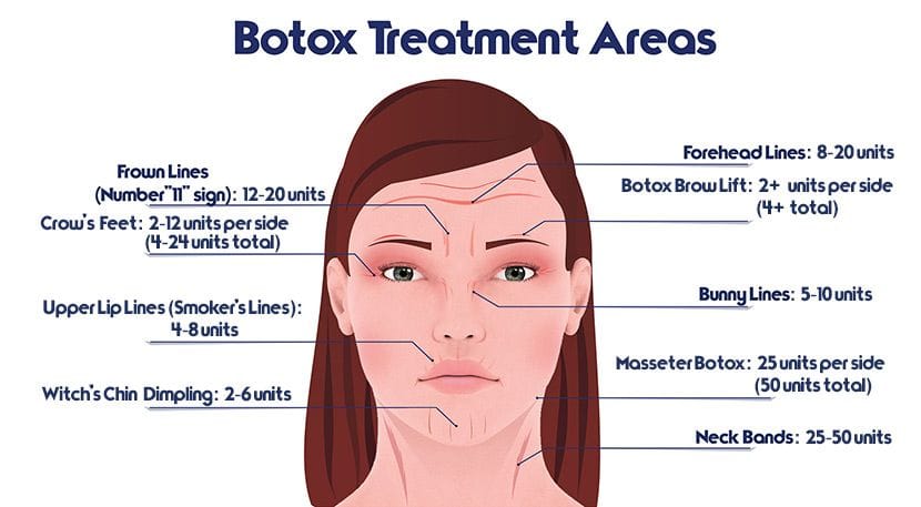 BOTOX infographic