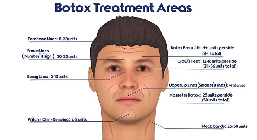 BOTOX infographic
