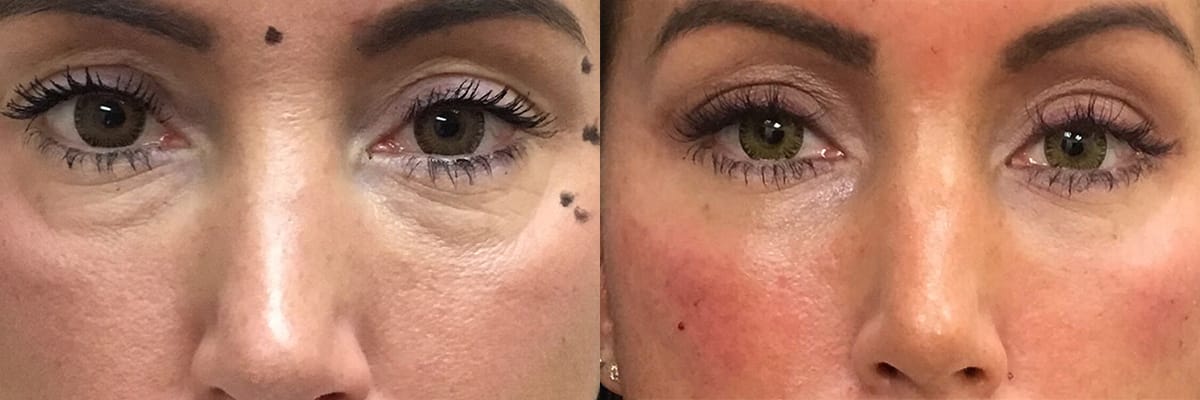 before and after fillers