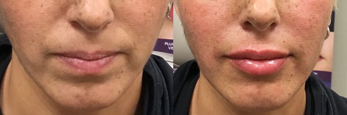 before and after fillers