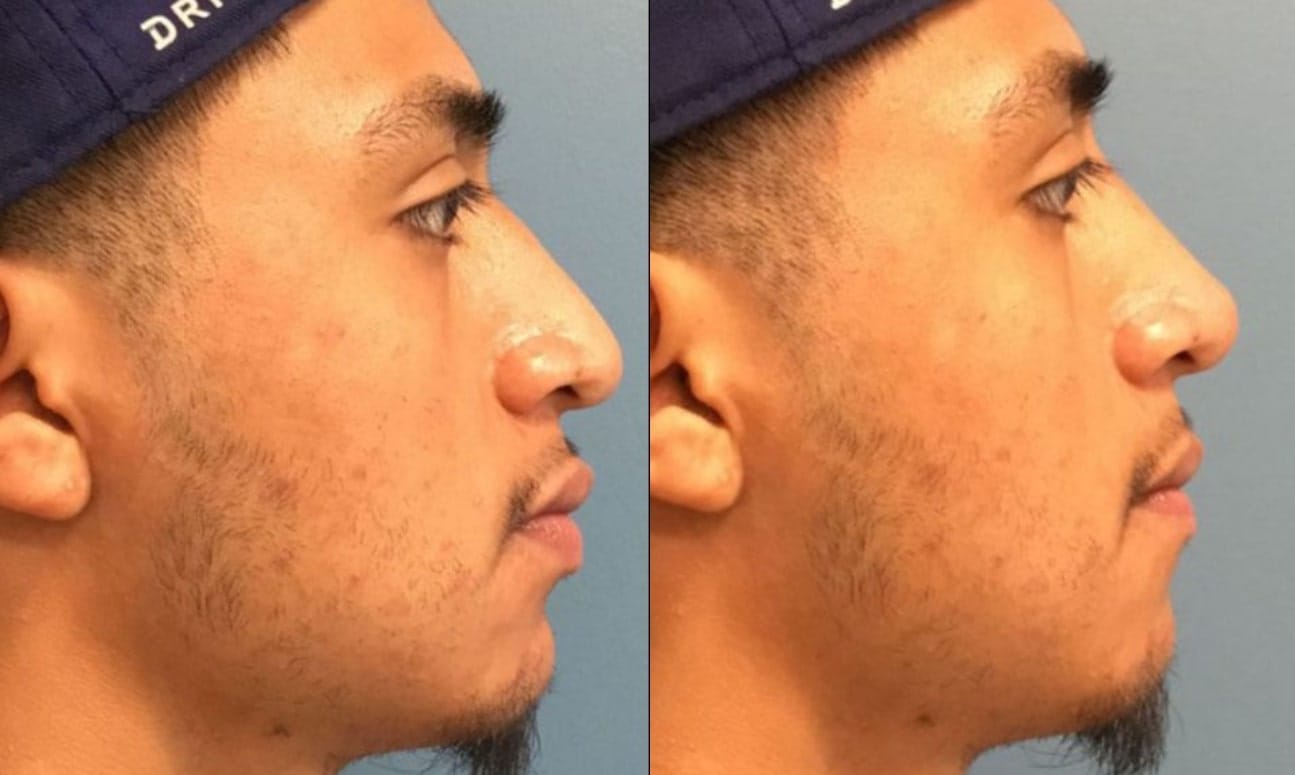 before and after fillers