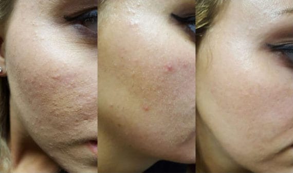 chemical peel results