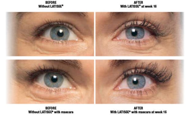 latisse results