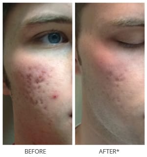 rf microneedling results