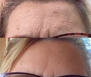 rf microneedling results