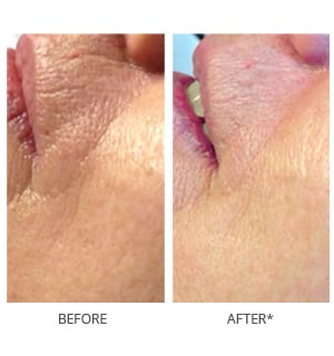 rf microneedling results