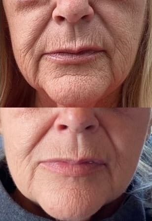 rf microneedling results