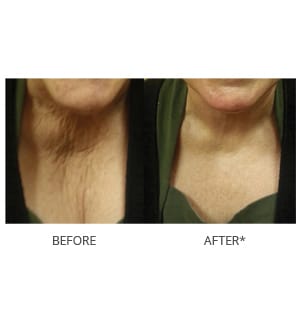 rf microneedling results