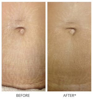 rf microneedling results