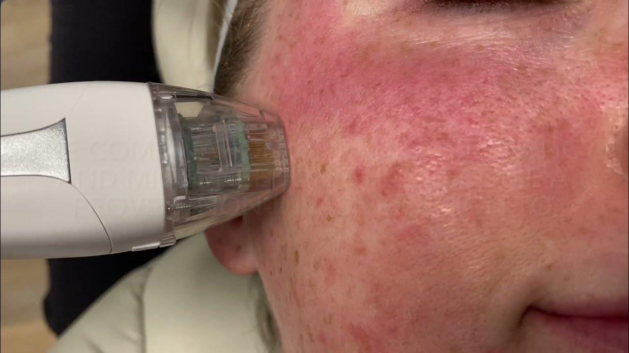 rf microneedling treatment