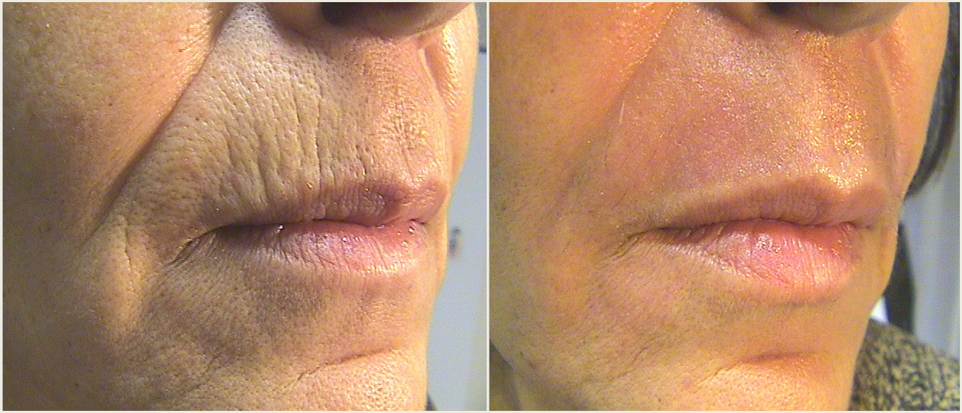 coolpeel results