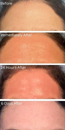 coolpeel results