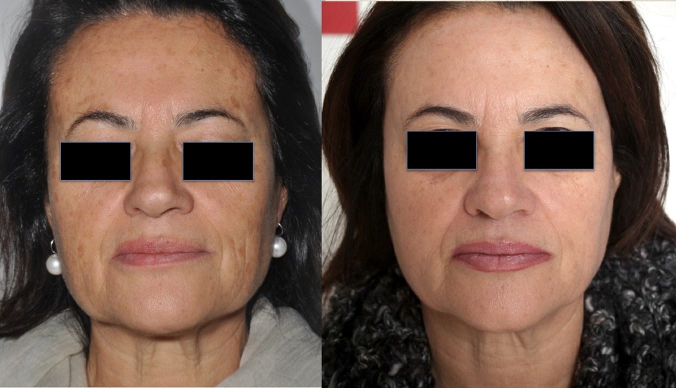 coolpeel results
