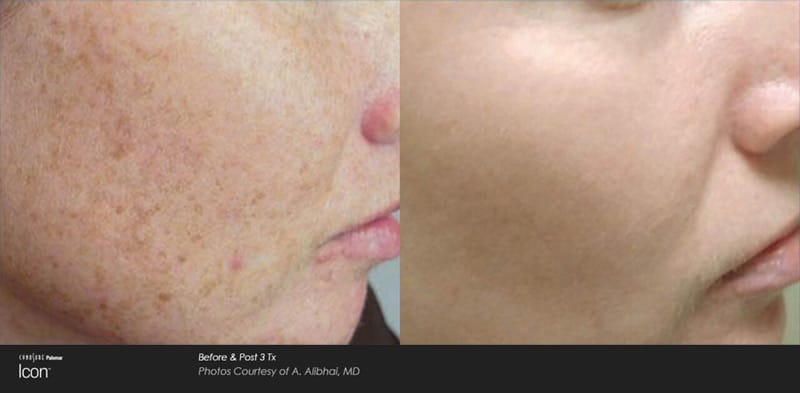 ipl photofacial results