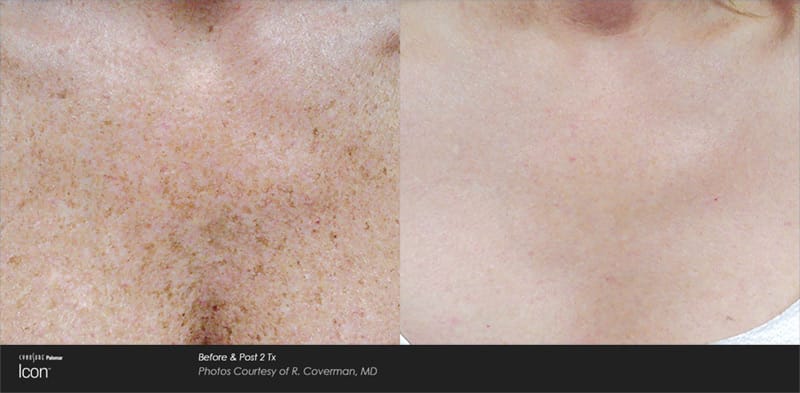 ipl photofacial results