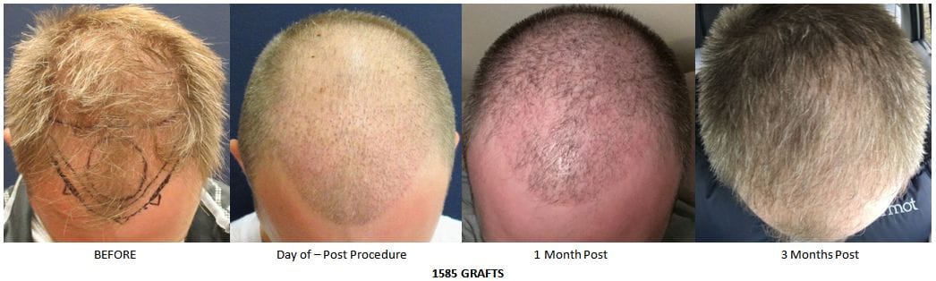 Follicular Unit Transplantation with FUE results