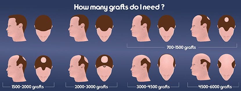 hair grafting infographic