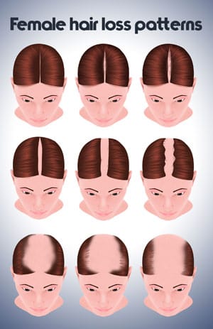 female hair loss patterns illustration