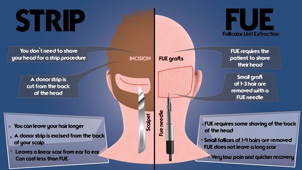 strip vs fue infographic