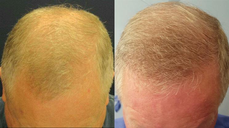 Follicular Unit Transplantation with FUE results