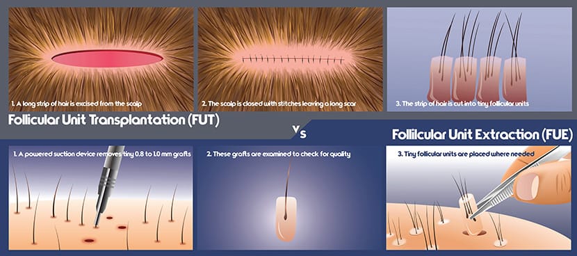 FUE procedure recovery illustration