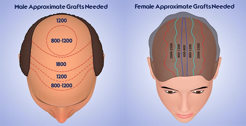 hair transplant infographic
