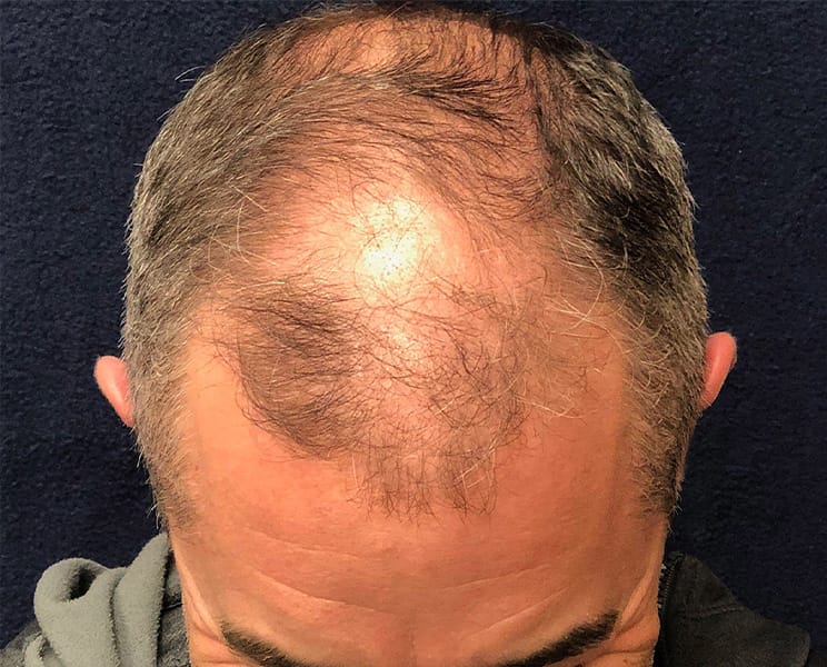 hair transplant patient