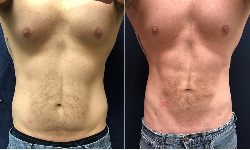 liposuction results