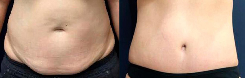 tummy tuck results