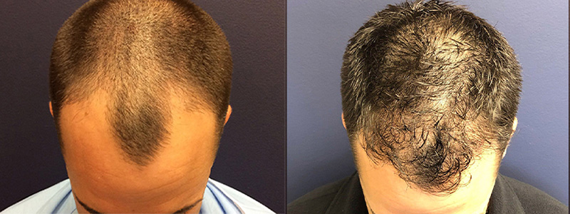 hair restoration results
