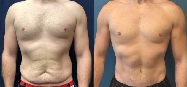 male tummy tuck results 
