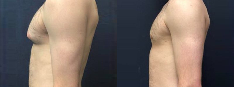 male breast reduction results