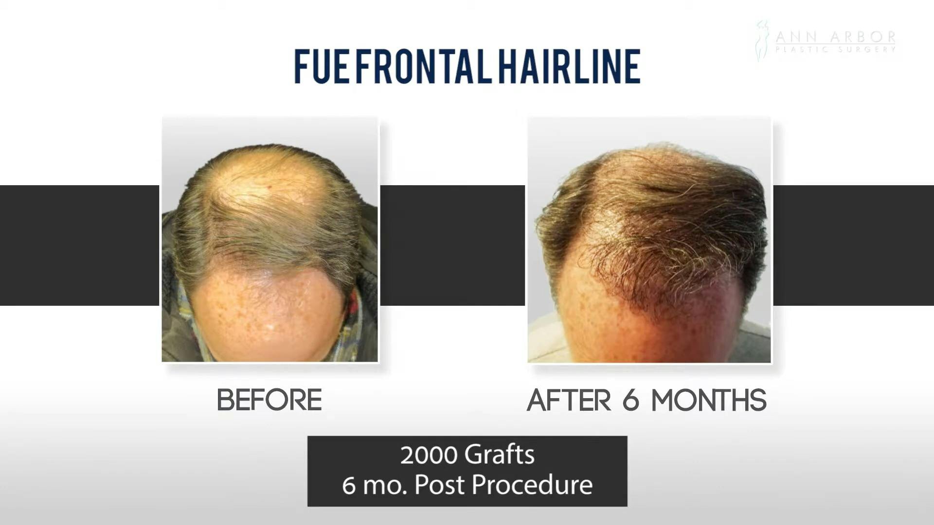 hair restoration video