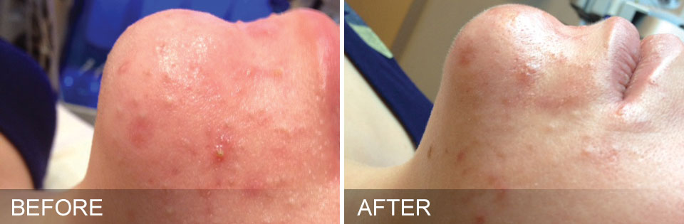 hydrafacial results