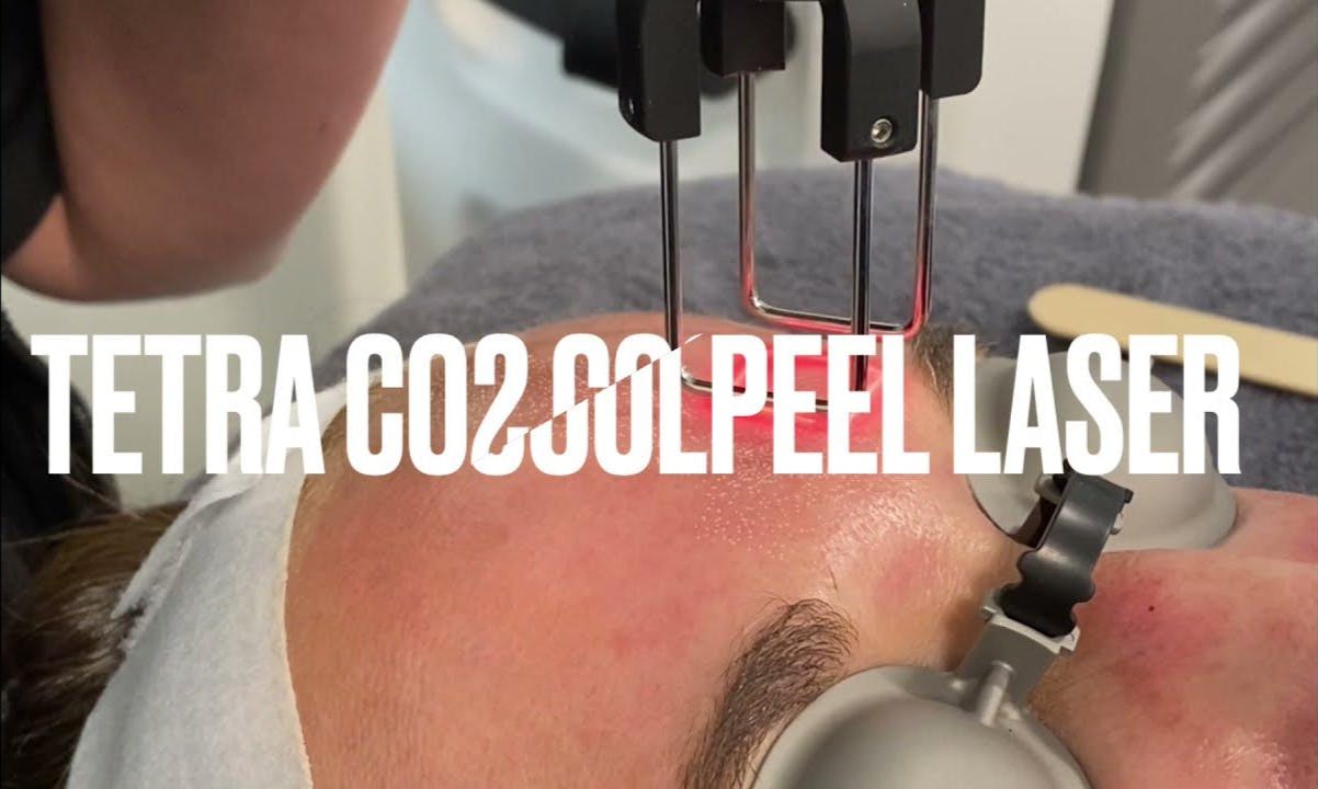 tetra coolpeel laser video