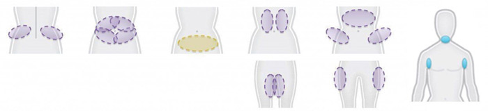 coolsculpting infographic